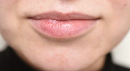 London Lip Clinic Bild 2