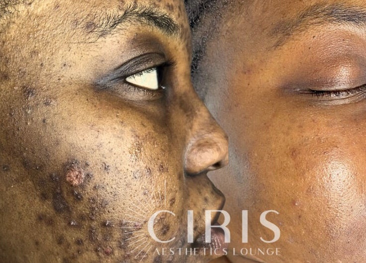 Before and after skin treatment at CIRIS, Lagos, Lagos, NG showcasing significant improvement in complexion.