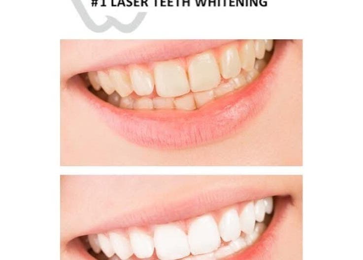 Before and after teeth whitening at Chloe Louise, Otley, England, GB. Noticeable improvement in dental aesthetics.