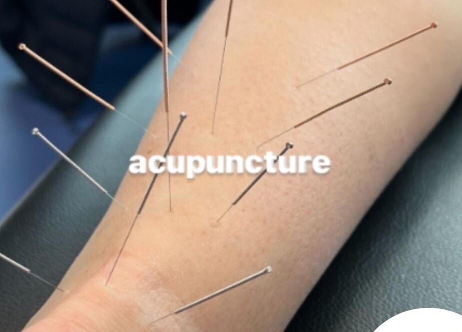 Acupuncture session at Breathe and Bloom Holistics in Wakefield, England, GB, showcasing traditional healing methods.