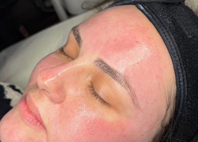 Freshly treated glowing skin at J Ludusan Beauty, Dublin, County Dublin, IE showcasing rejuvenation.