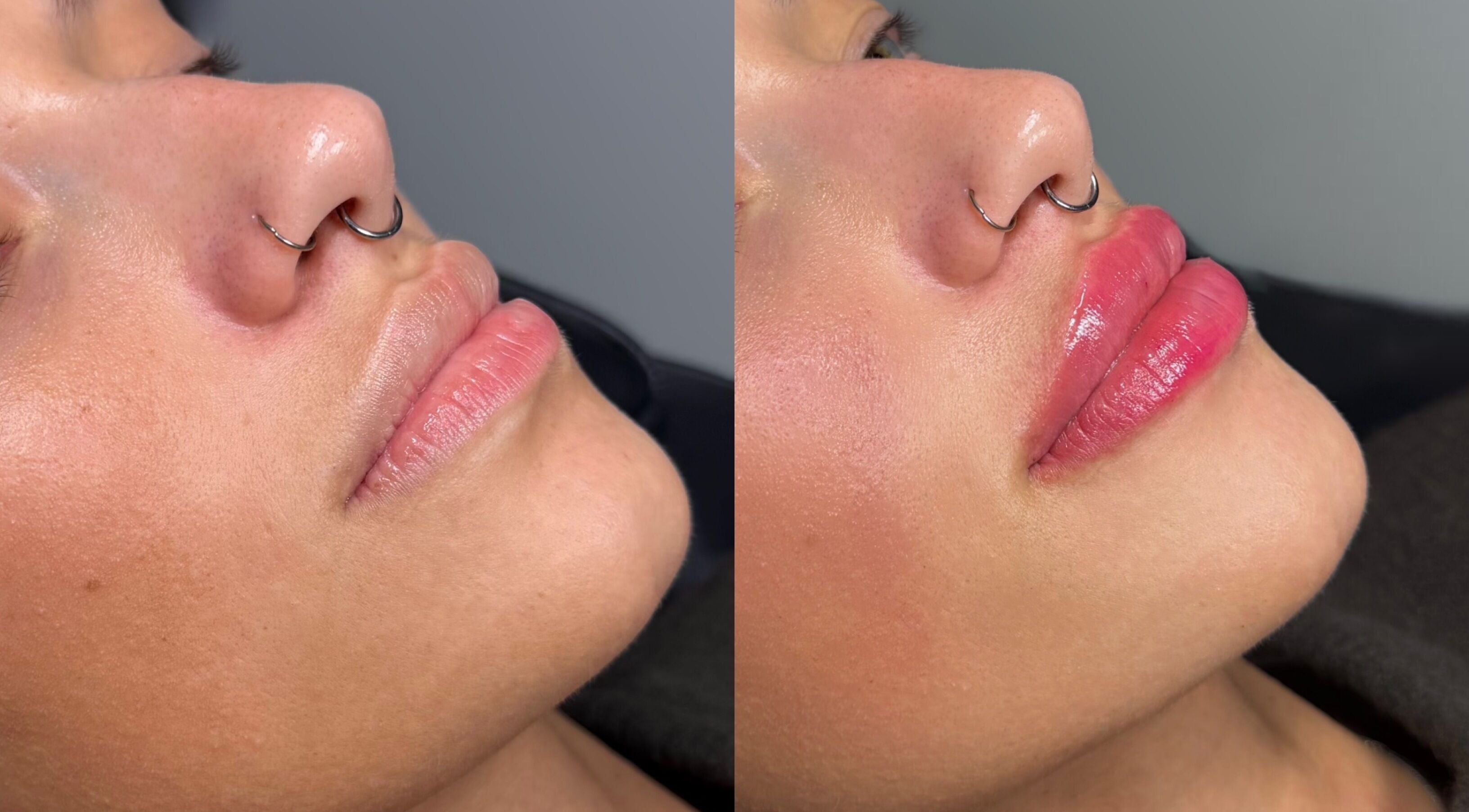 Before and after lip enhancement at Nova Luxe, Pudsey, England, GB showcasing fuller lips.