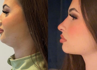 Side profile before and after results of beauty treatment at Muse Aesthetics, Greenford, England, GB.