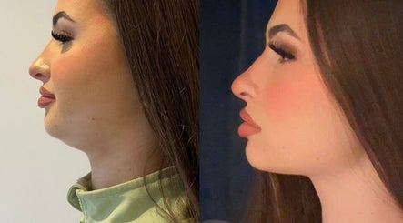 Side profile before and after results of beauty treatment at Muse Aesthetics, Greenford, England, GB.