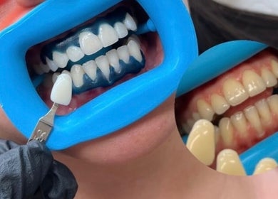 Advanced teeth whitening at Muse Aesthetics in Greenford, England, GB showing remarkable before and after results.