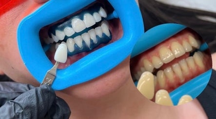Advanced teeth whitening at Muse Aesthetics in Greenford, England, GB showing remarkable before and after results.