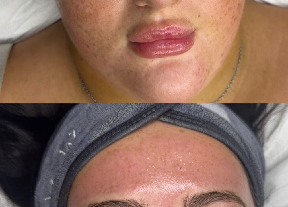 Before and after skincare treatment at Nu Glow by Teri, Worsley, England, GB showcasing clear, rejuvenated skin.