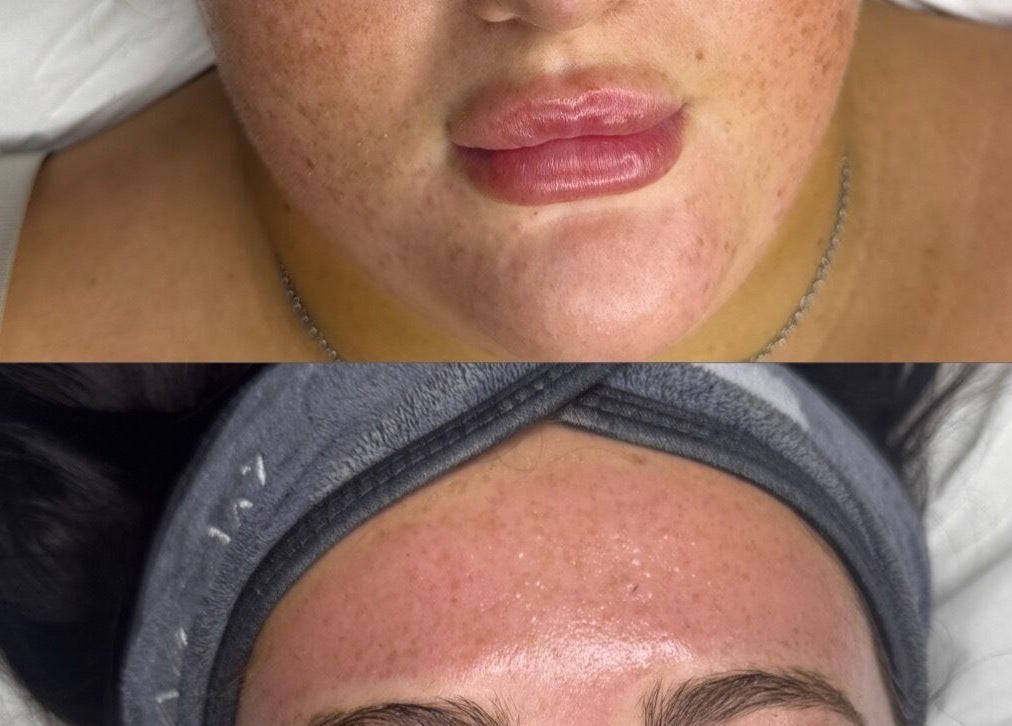 Before and after skincare treatment at Nu Glow by Teri, Worsley, England, GB showcasing clear, rejuvenated skin.