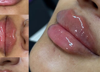 Close-up of glossy lips treatment at The Needle Room, London, England, GB. Enhancing natural beauty.