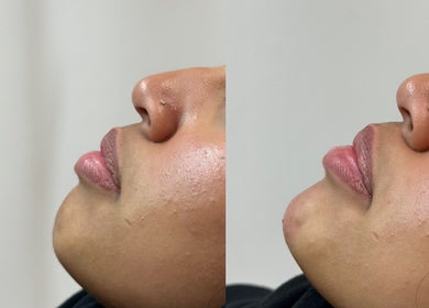 Before and after skin treatment at The Needle Room, London, England, GB showing improved skin texture.