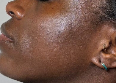 Side profile showcasing radiant skin after treatment at The Needle Room, London, England, GB.
