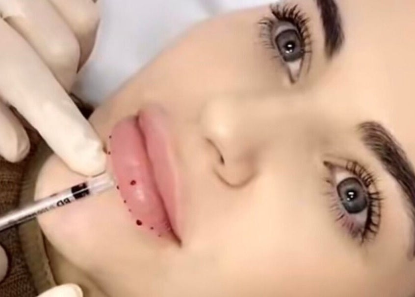 Lip enhancement at Snatched Aesthetics Rockdale, New South Wales, AU, featuring precise injection technique.