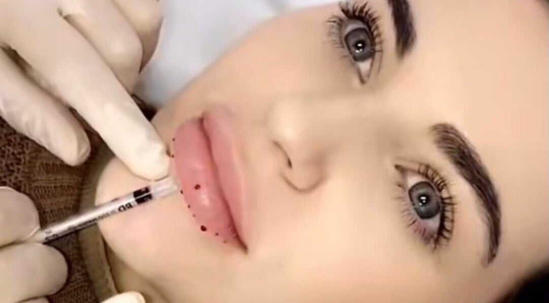 Lip enhancement at Snatched Aesthetics Rockdale, New South Wales, AU, featuring precise injection technique.