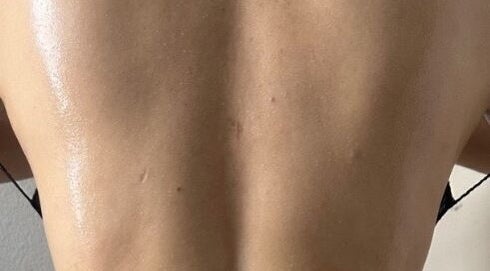 Back treatment at Hello Waistline in Bell Gardens, California, US, showcasing smooth, glowing skin.