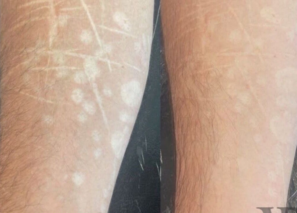 Before and after skin treatment at Enhancing Faces, Lytham St Annes, England, GB.