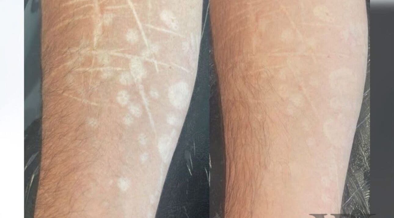 Before and after skin treatment at Enhancing Faces, Lytham St Annes, England, GB.