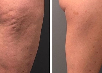 Metamorfoza cellulitu w Pro Masaż Anastasiya Rabets, Wrocław, Województwo Dolnośląskie, PL.