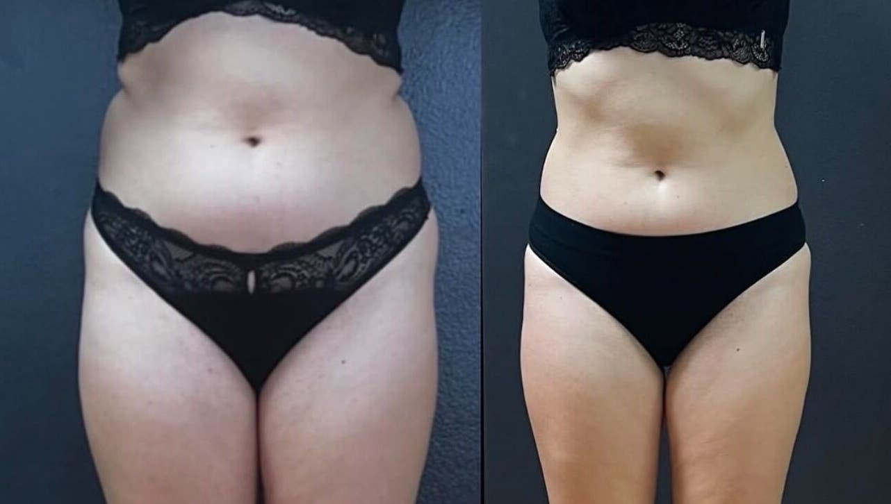 Before and after body contouring results at Wrap & Shape, Ashbourne, County Meath, IE.