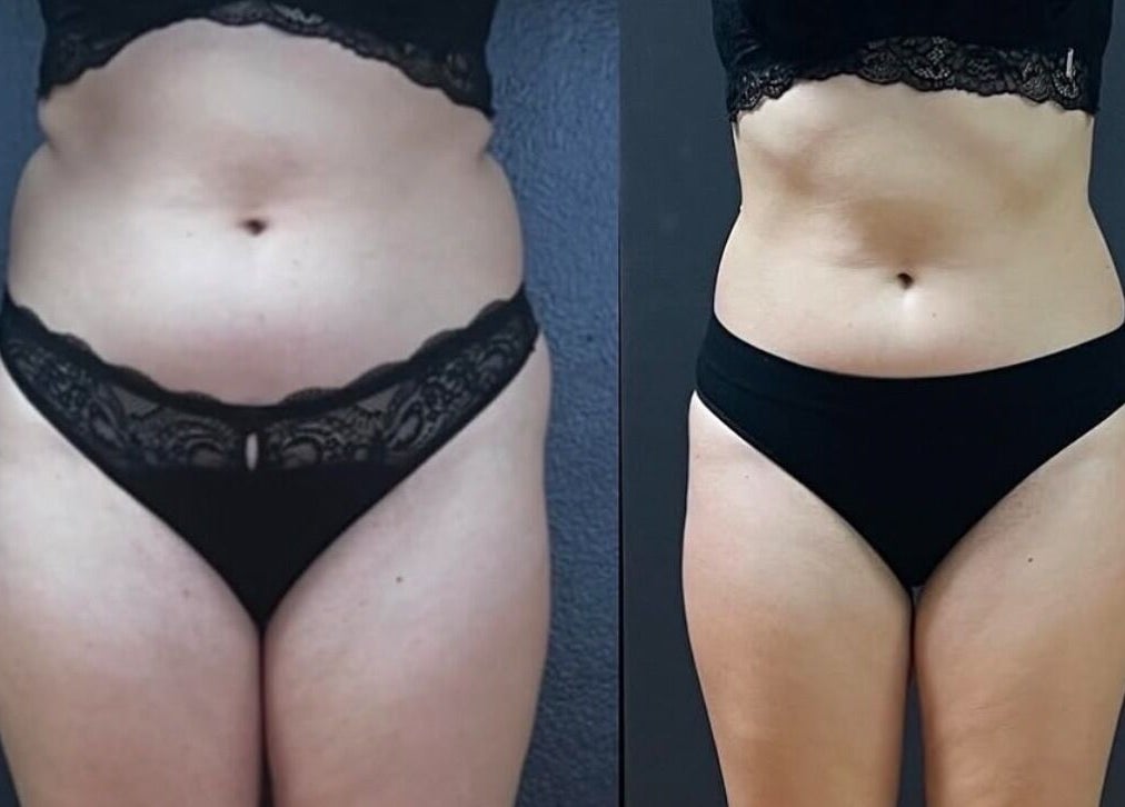 Before and after body contouring results at Wrap & Shape, Ashbourne, County Meath, IE.