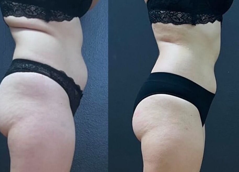 Before and after body contouring at Wrap & Shape, Ashbourne, County Meath, IE.