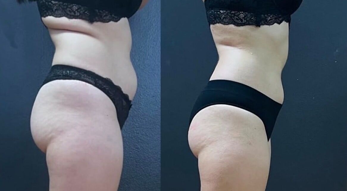 Before and after body contouring at Wrap & Shape, Ashbourne, County Meath, IE.