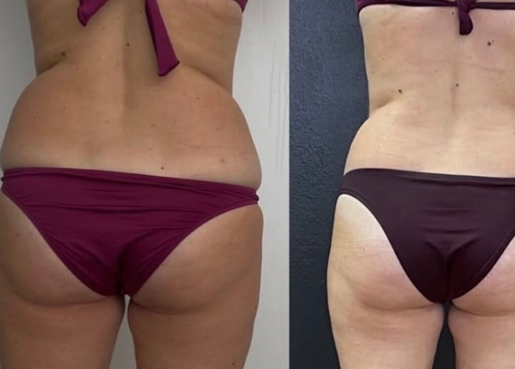 Before and after body contouring at Wrap & Shape, Ashbourne, County Meath, IE.