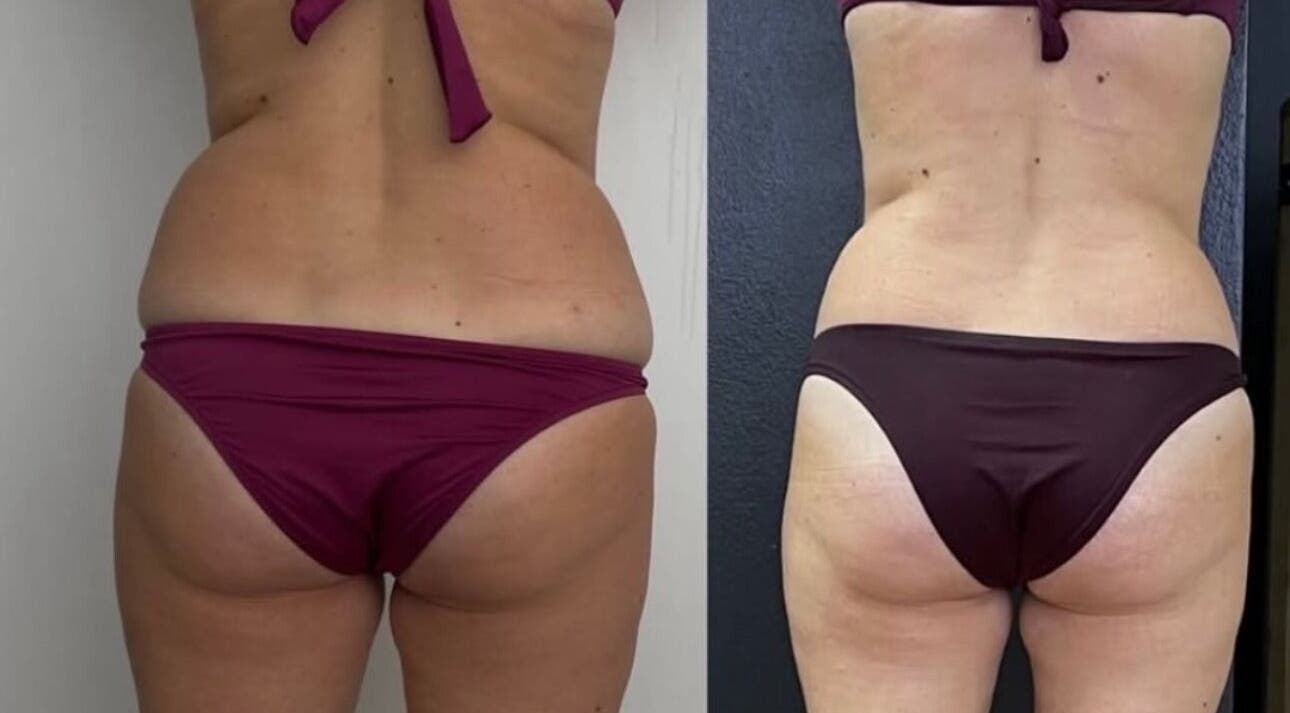 Before and after body contouring at Wrap & Shape, Ashbourne, County Meath, IE.