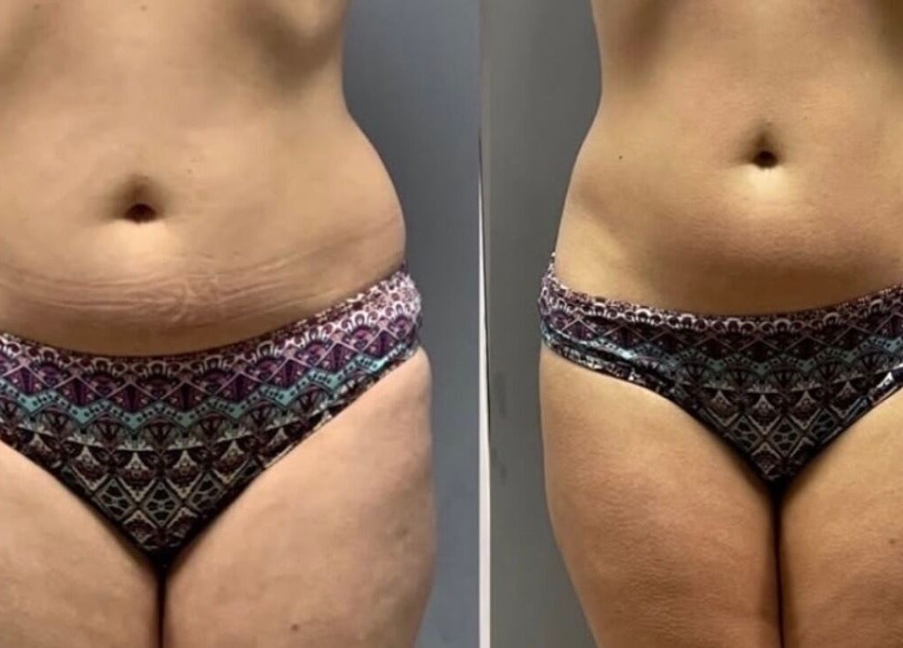 Before and after body contouring at Wrap & Shape, Ashbourne, County Meath, IE.