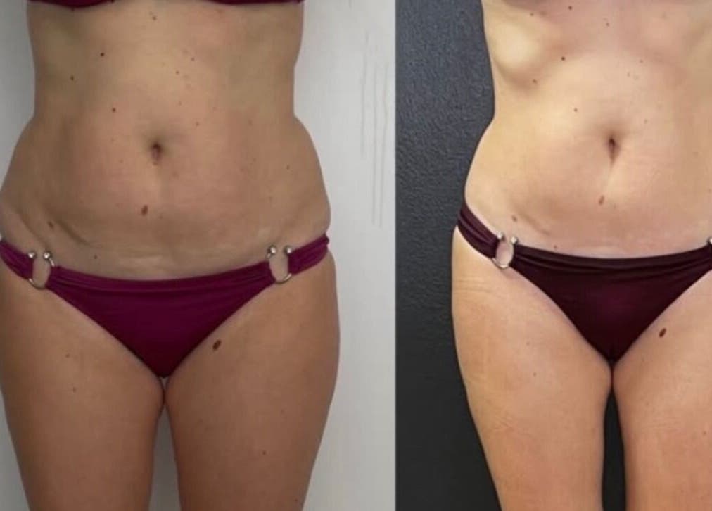 Before and after contouring results at Wrap & Shape, Ashbourne, County Meath, IE.