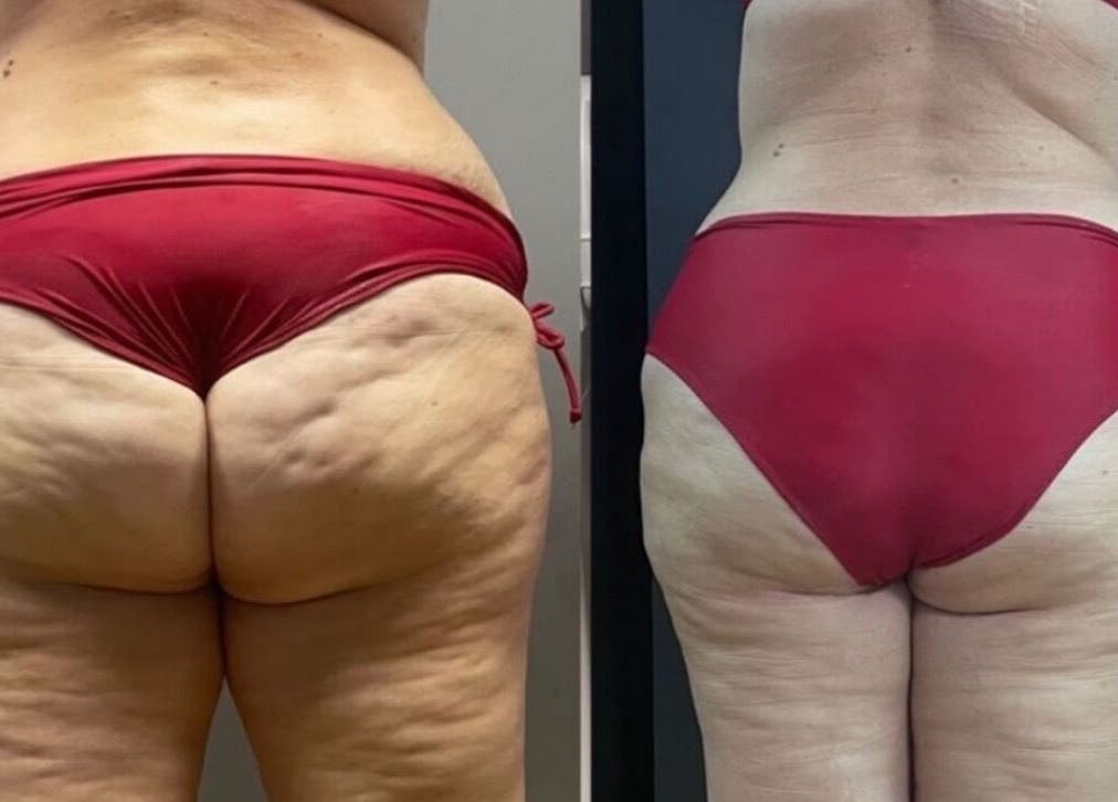 Before and after body shaping at Wrap & Shape in Ashbourne, County Meath, IE.