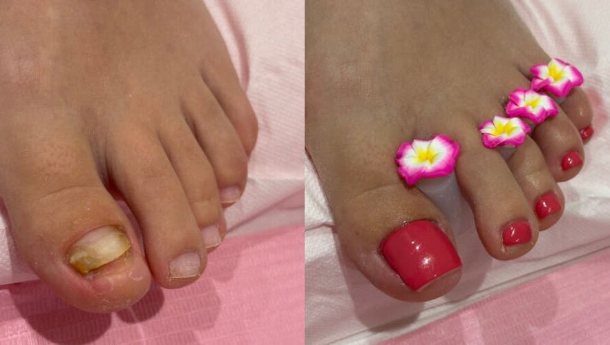 Toenail Reconstruction @ RSB Studios in Nottingham, England with pink nail polish and floral separators.