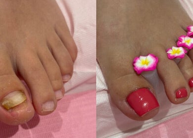 Toenail Reconstruction @ RSB Studios in Nottingham, England with pink nail polish and floral separators.