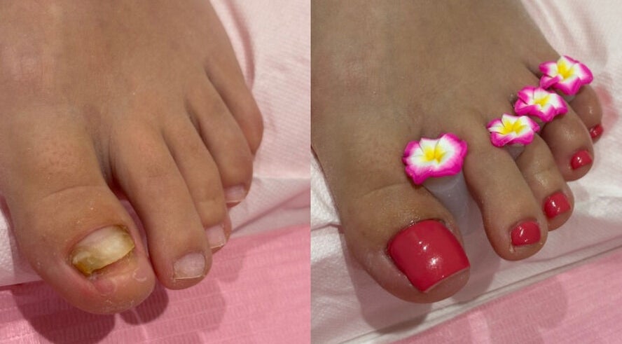 Toenail Reconstruction @ RSB Studios in Nottingham, England with pink nail polish and floral separators.