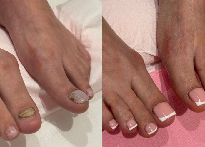 Toenail reconstruction at RSB Studios, Nottingham, England, GB before and after transformation.