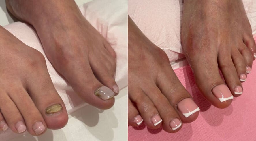 Toenail reconstruction at RSB Studios, Nottingham, England, GB before and after transformation.