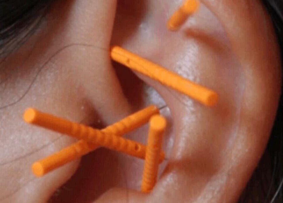 Ear acupuncture therapy session at Apple Lodge Therapies in Redditch, England, GB with vibrant orange needles.
