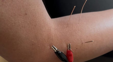 Acupuncture therapy at Capture Relaxation, Paradise Hill, Saskatchewan, CA. Enhance your wellness naturally.