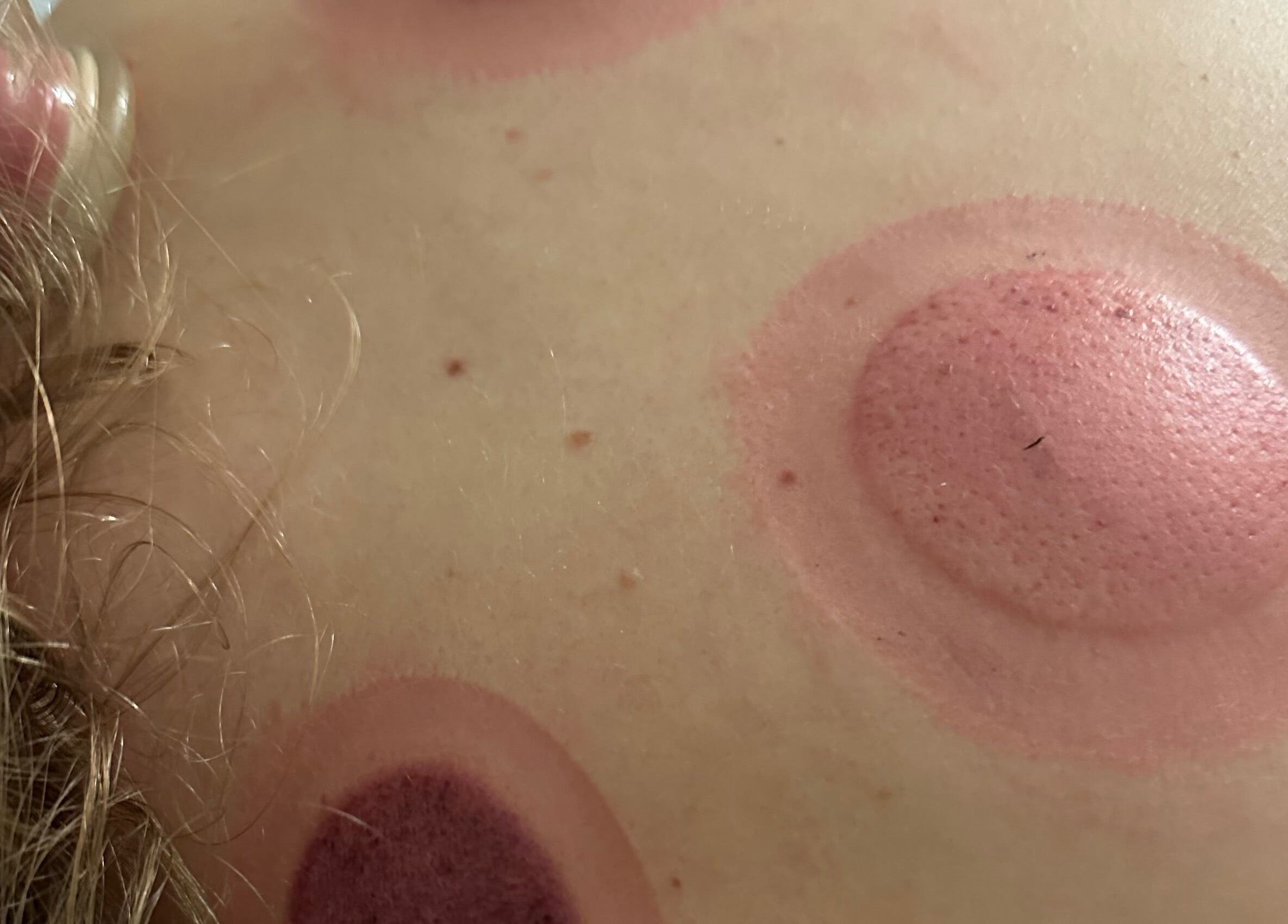 Cupping marks on skin during therapy at Capture Relaxation, Paradise Hill, Saskatchewan, CA.