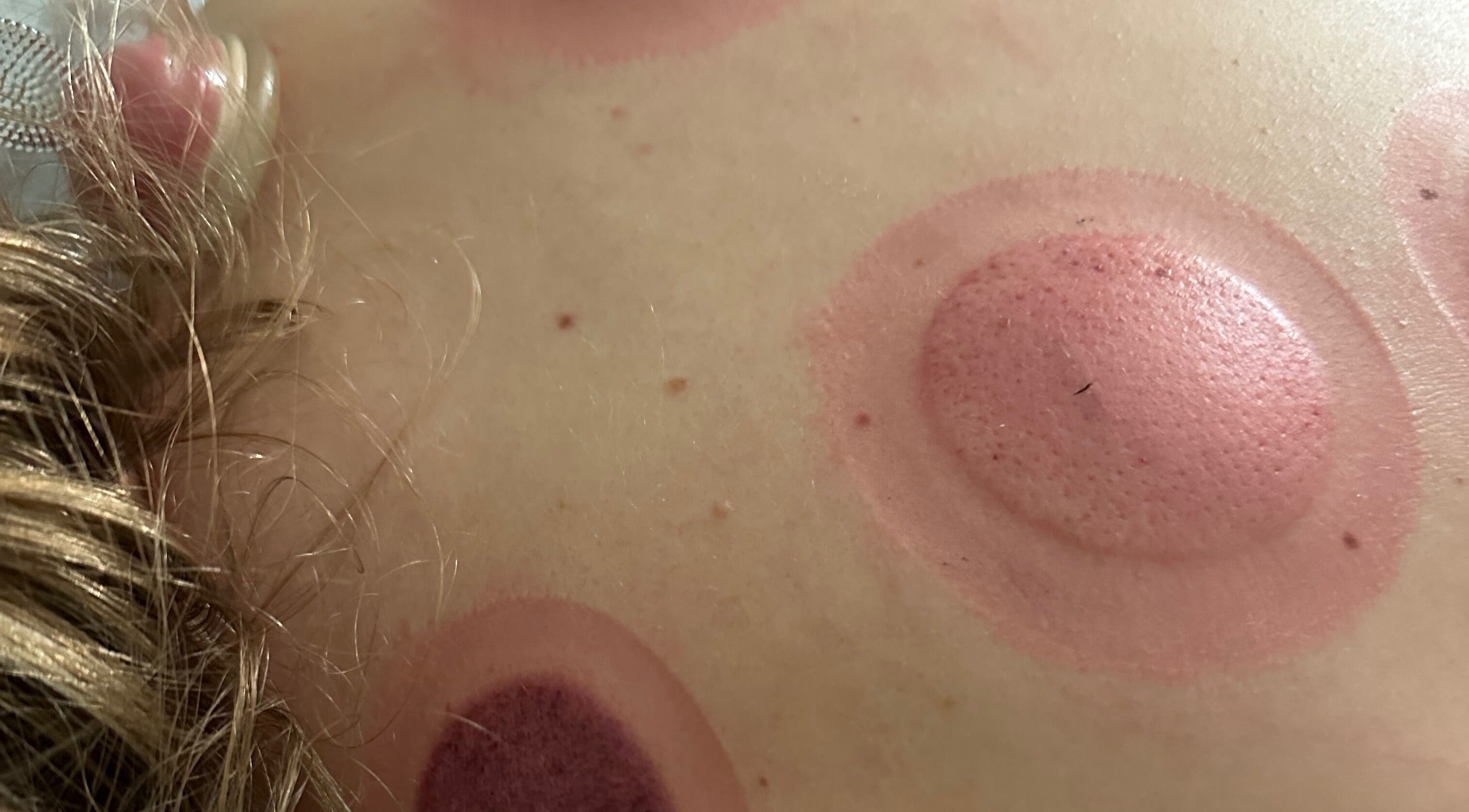 Cupping marks on skin during therapy at Capture Relaxation, Paradise Hill, Saskatchewan, CA.