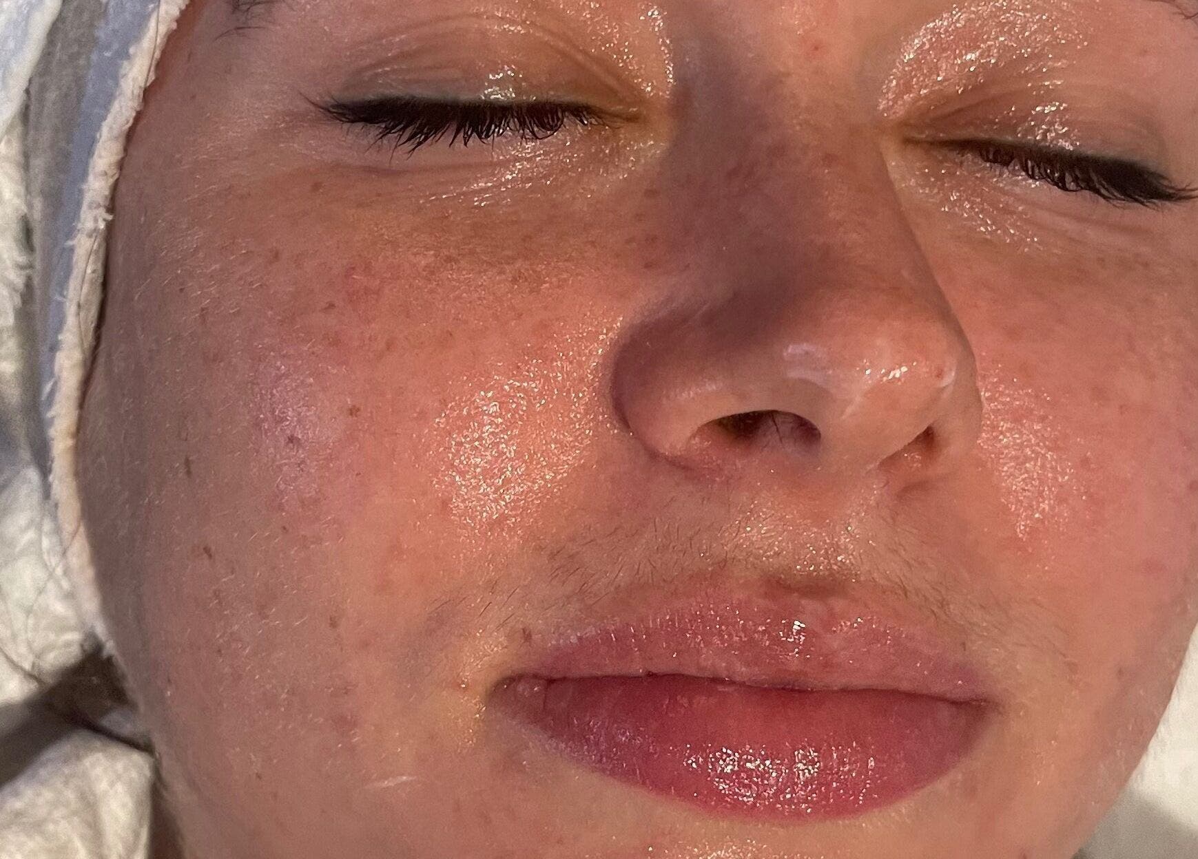 Close-up of a freshly treated face at LOVESTETIC in Abingdon, England, GB, showcasing smooth and glowing skin.