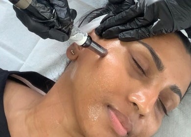 Microneedling treatment at Absolute Skin & Aesthetics Fareham, Fareham, England, GB rejuvenates skin.