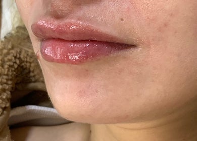 Close-up of glossy lips after treatment at Absolute Skin & Aesthetics Fareham, Fareham, England, GB.