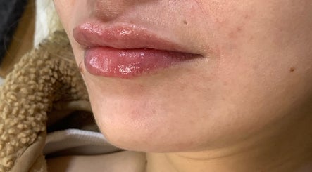 Close-up of glossy lips after treatment at Absolute Skin & Aesthetics Fareham, Fareham, England, GB.