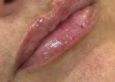 Close-up of glossy lips treated at Absolute Skin & Aesthetics Fareham, Fareham, England, GB.