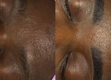 Before and after skincare treatment at Pretty Girls Aesthetics, Buffalo, New York, US.