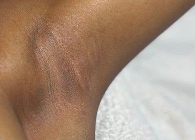Close-up of smooth skin on an arm at Pretty Girls Aesthetics, Buffalo, NY, US.