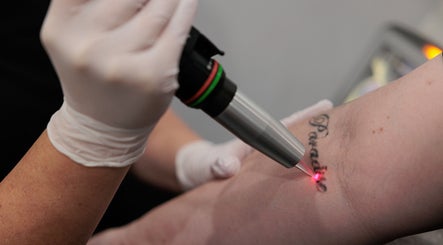 Tattoo Removal Mackay slika 3