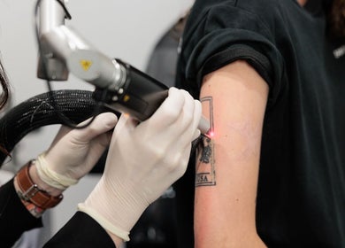 Tattoo removal procedure at Tattoo Removal Mackay, North Mackay, Queensland, AU with laser equipment.