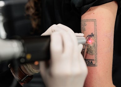 Tattoo removal in progress at Emma McCulloch Tattoo Removal & Aesthetics, Everton Park, Queensland, AU.