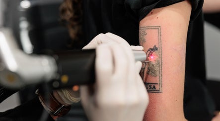 Tattoo removal in progress at Emma McCulloch Tattoo Removal & Aesthetics, Everton Park, Queensland, AU.